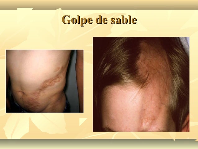 esclerodermia en sable